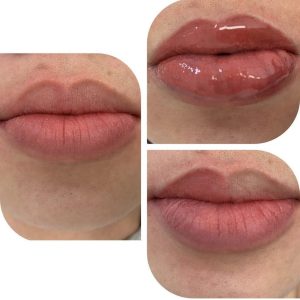 This client had a brown melanin rich upper lip which we neutralized to a blush pink to match the lower lip